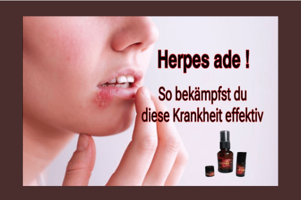 Herpes adé - so bekämpfst du die Krankheit effektiv