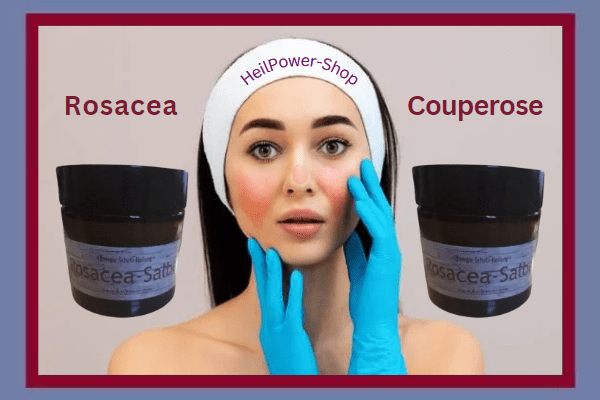 Rosacea-Salbe: Heilsame Power für eine makellose Haut - Entdecken Sie die Wunderwirkung dieser revolutionären Salbe!